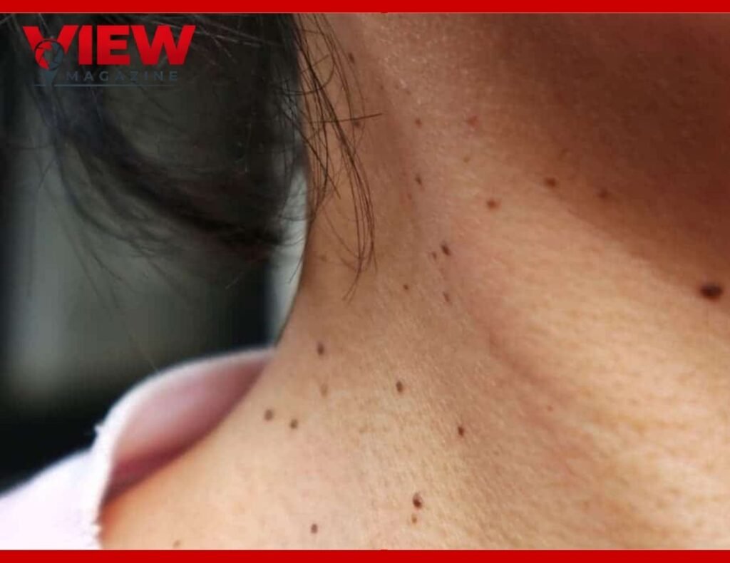 Skin Tag Treatment at Home